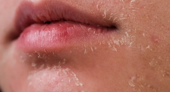 Medikal Peeling Uygulamaları