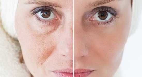 Mezoterapi Uygulamaları