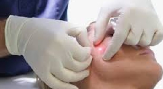 Endolazer Uygulamaları